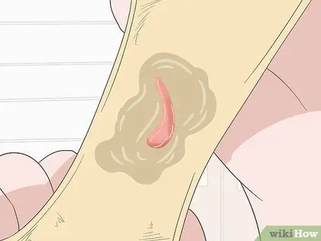 Определите разницу между менструацией и выкидышем Шаг 3