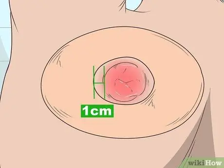 Нанесите Moleskin Step 3