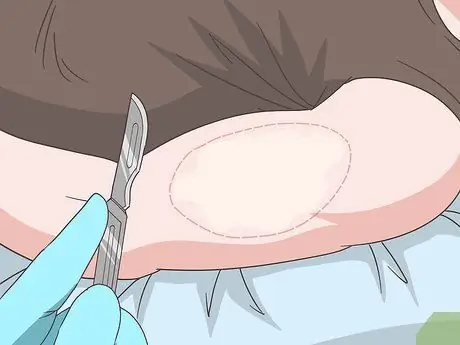 Как предотвратить ухудшение состояния витилиго Шаг 10