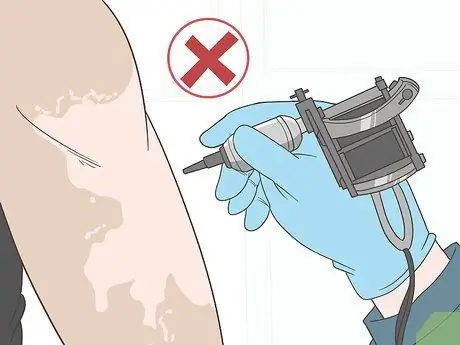 Как предотвратить ухудшение состояния витилиго Шаг 4