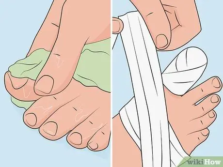 Быстро залечить ушибленный ноготь на ноге, шаг 07