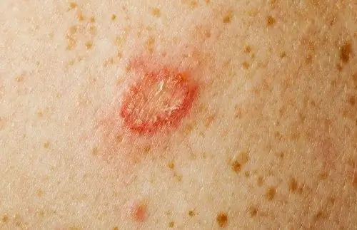 La tiña эс уно де лос типос де hongos en la piel La tiña эс уно де лос типос де hongos en la piel