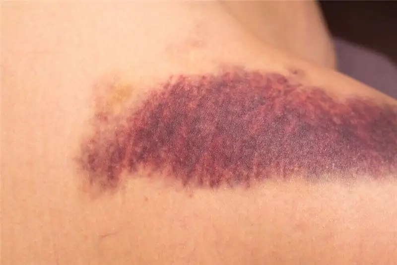 Синяк из-за дефицита витамина К