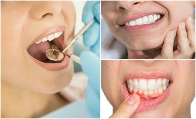 7 симптомов, которые могут указывать на зубную инфекцию