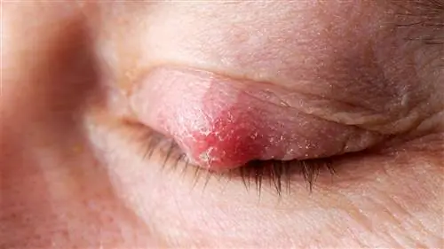 Что такое халязион? Симптомы, причины, диагностика, лечение и профилактика