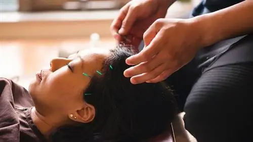 женщина получает иглоукалывание