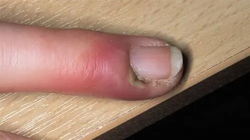 изменения ногтей