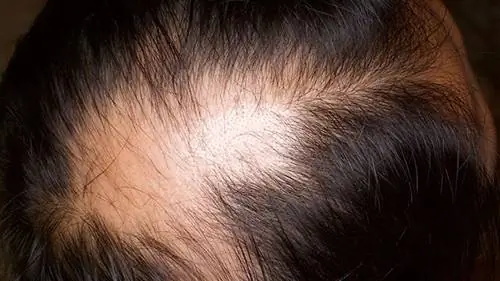 выпадение волос, облысение