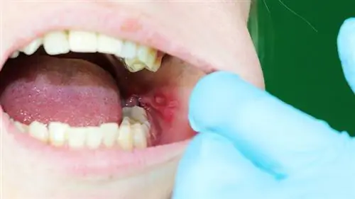 язвы во рту