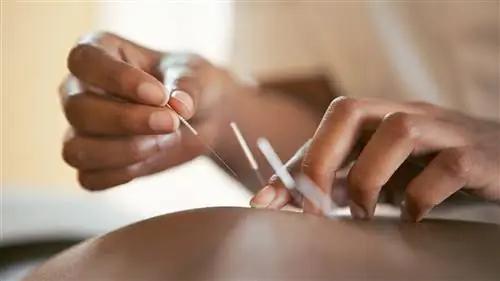 человек, получающий иглоукалывание от хронической боли