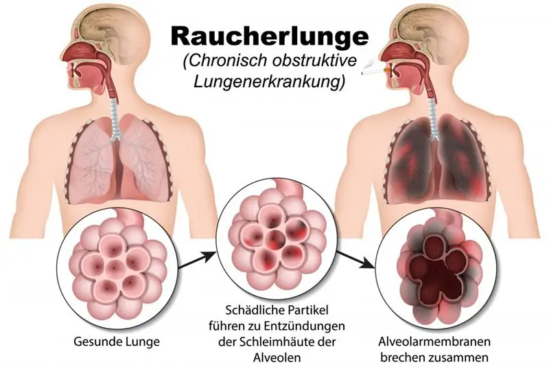 Хроническая обструктивная болезнь легких, легкое курильщика