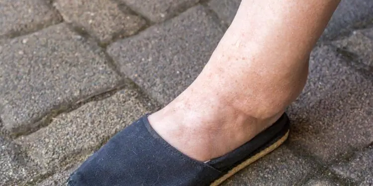 У женщины опухла нога из-за задержки воды