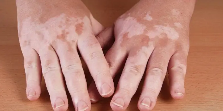 Руки с большими белыми пятнами на коже