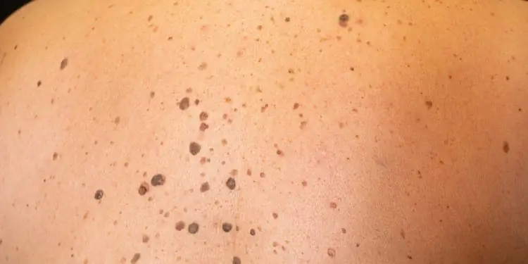 Спина с множеством видимых родимых пятен