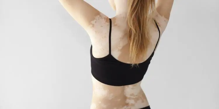 Вид сзади женщины с витилиго