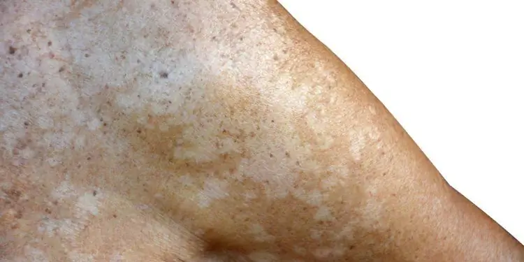 Плечо и предплечье с белыми пятнами кожи, вызванными отрубевидным лишаем