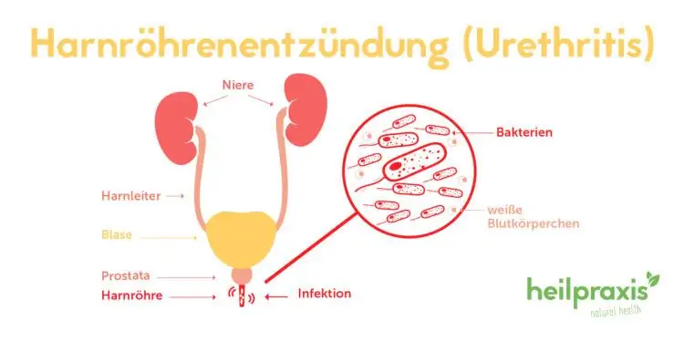 Изображение мужской мочевыделительной системы, показывающее воспаление в уретре наряду с увеличенным изображением бактериальных патогенов