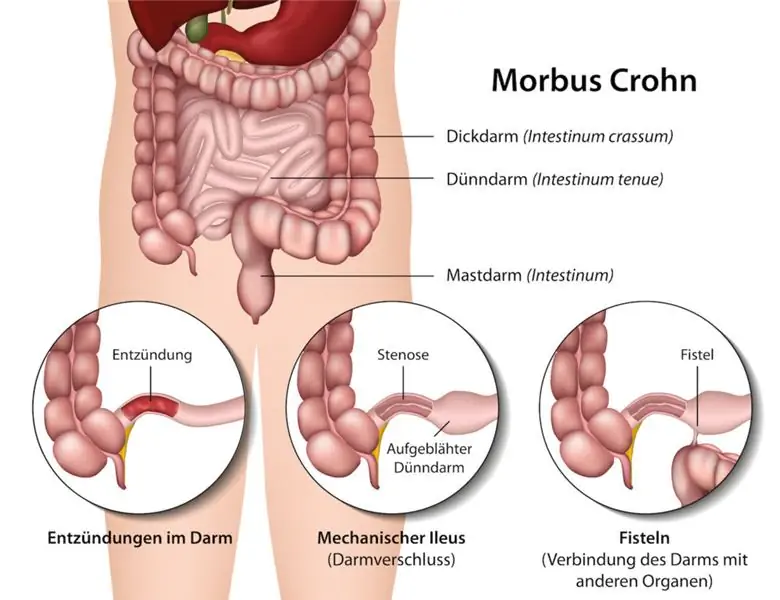 Болезнь Крона - тяжелое кишечное заболевание различной степени тяжести. Изображение: Bilderzwerg-fotolia