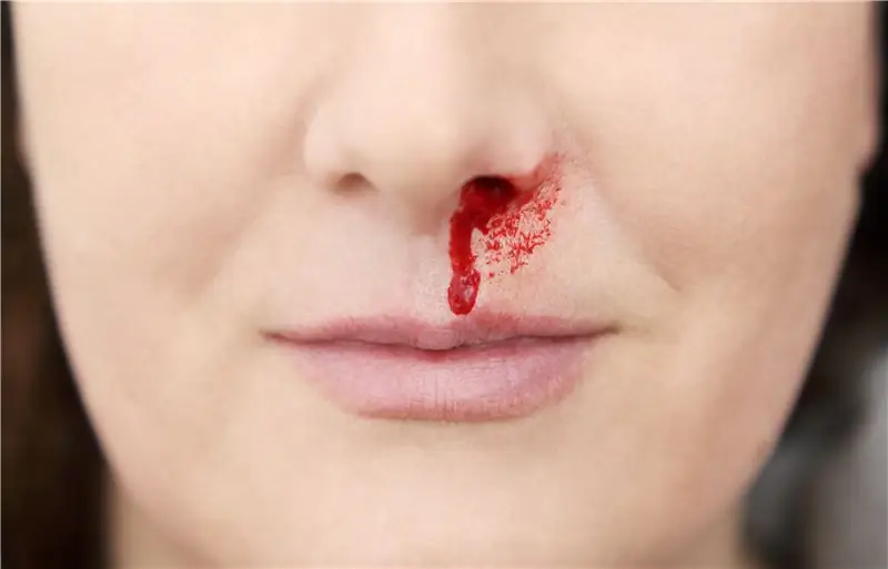 Носовые кровотечения - причины, лечение и симптомы