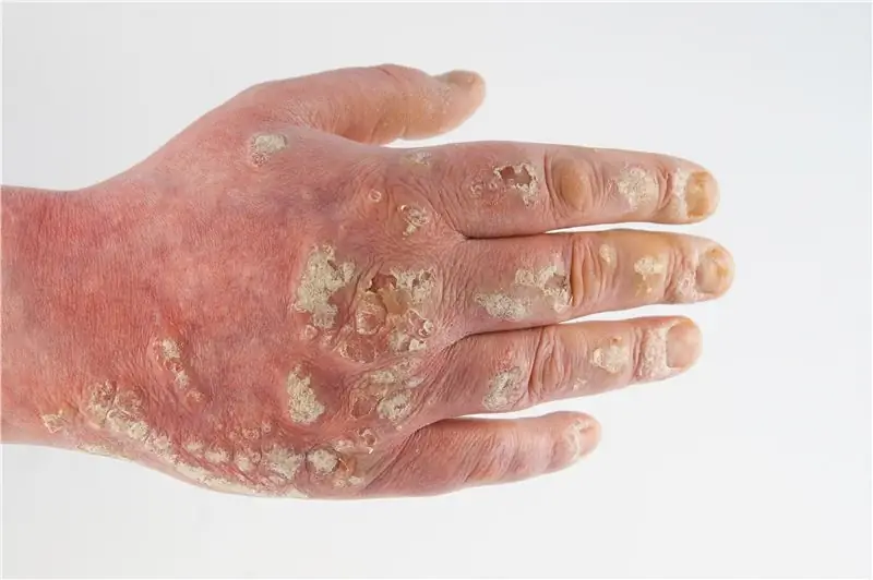 Кожный лишай: симптомы и лечение