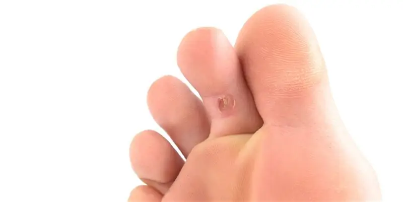 Лучшие домашние средства от мозолей