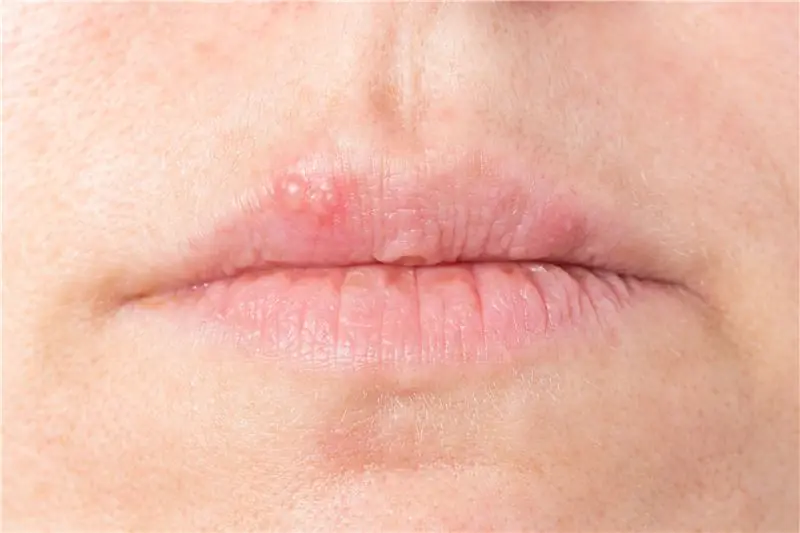 Домашние средства от герпеса (герпеса)