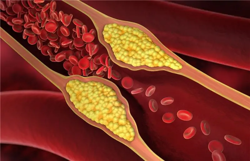 Питание: успешное снижение высокого уровня холестерина