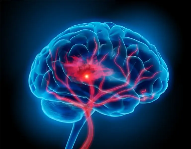 Плохой образ жизни оказывает значительно большее влияние на риск инсульта, чем гены