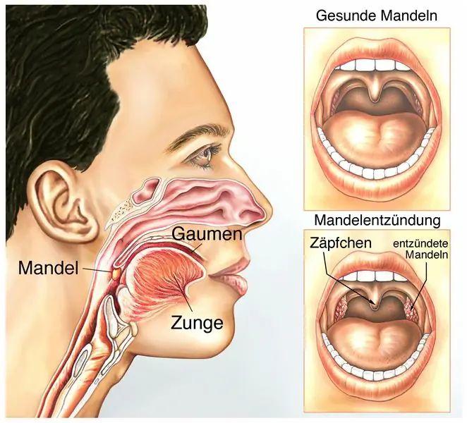 Тонзиллэктомия повышает риск инфекционных заболеваний и аллергии