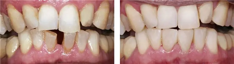 Советы экспертов: Щель между зубами – что делать?