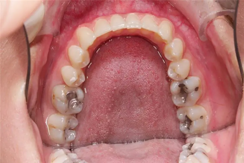 Но никакой компенсации за боль и страдания из-за пломб из амальгамы. Изображение: artepicturas - fotolia