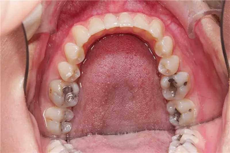 Вердикт: Отсутствие компенсации боли и страданий из-за пломбирования зубов из амальгамы