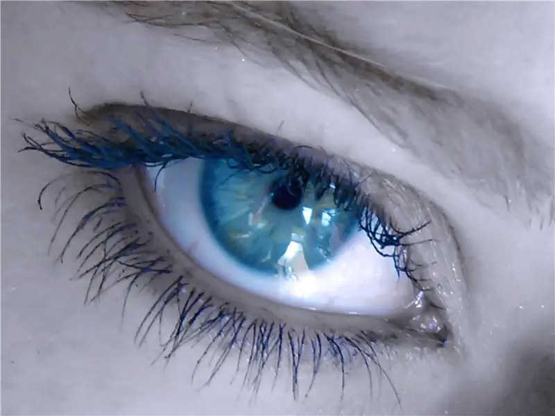 Рассеянный склероз часто впервые диагностируется офтальмологом