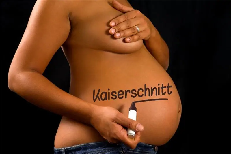 Все больше и больше женщин хотят сделать кесарево сечение. (Изображение: VRD - фотолия)
