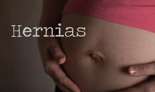 Грыжа во время беременности, когда необходима операция?