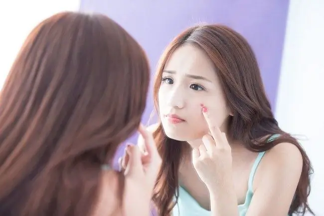 6 способов избавиться от воспаленных прыщей