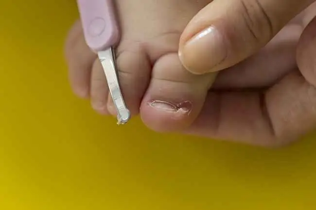 Мама, вот как справиться с вросшими ногтями на ногах у младенцев - Alodokter