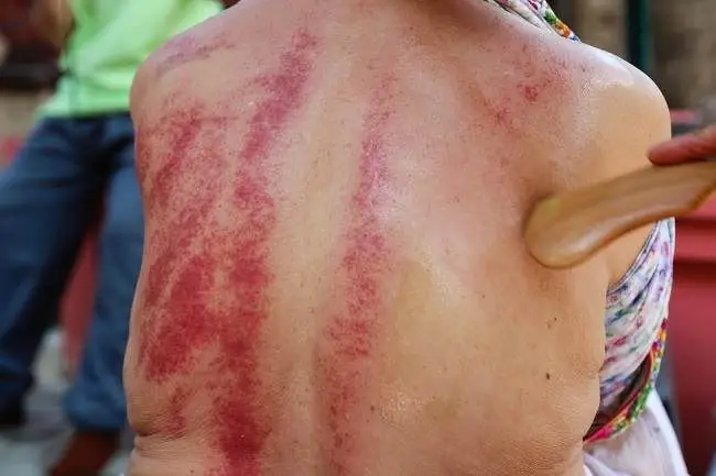 Знайте преимущества и риски скрейпинга с медицинской точки зрения