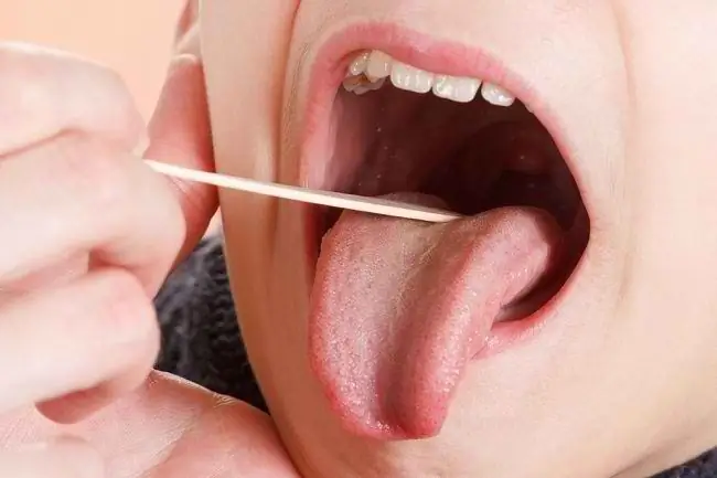 Знайте болезнь языка и как ее преодолеть - Alodokter Знайте болезнь языка и как ее преодолеть - Alodokter