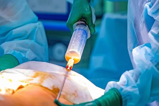 Липосакция, вот что вы должны знать - Alodokter