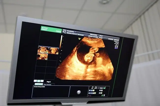 2 месяца беременности: от эмбриона к плоду - Alodokter 2 месяца беременности: от эмбриона к плоду - Alodokter
