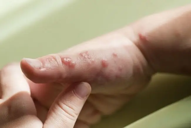 Понимание симптомов и соответствующее лечение кожного герпеса - Alodokter