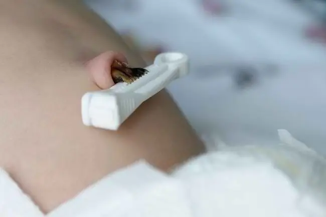 Шаги по уходу за пуповиной новорожденного - Alodokter Шаги по уходу за пуповиной новорожденного - Alodokter