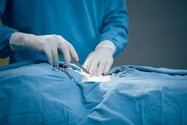 Гистерэктомия и состояния, при которых она требуется - Alodokter