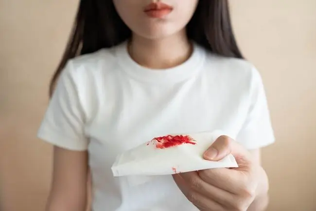 Острый миелобластный лейкоз - Симптомы, причины и лечение