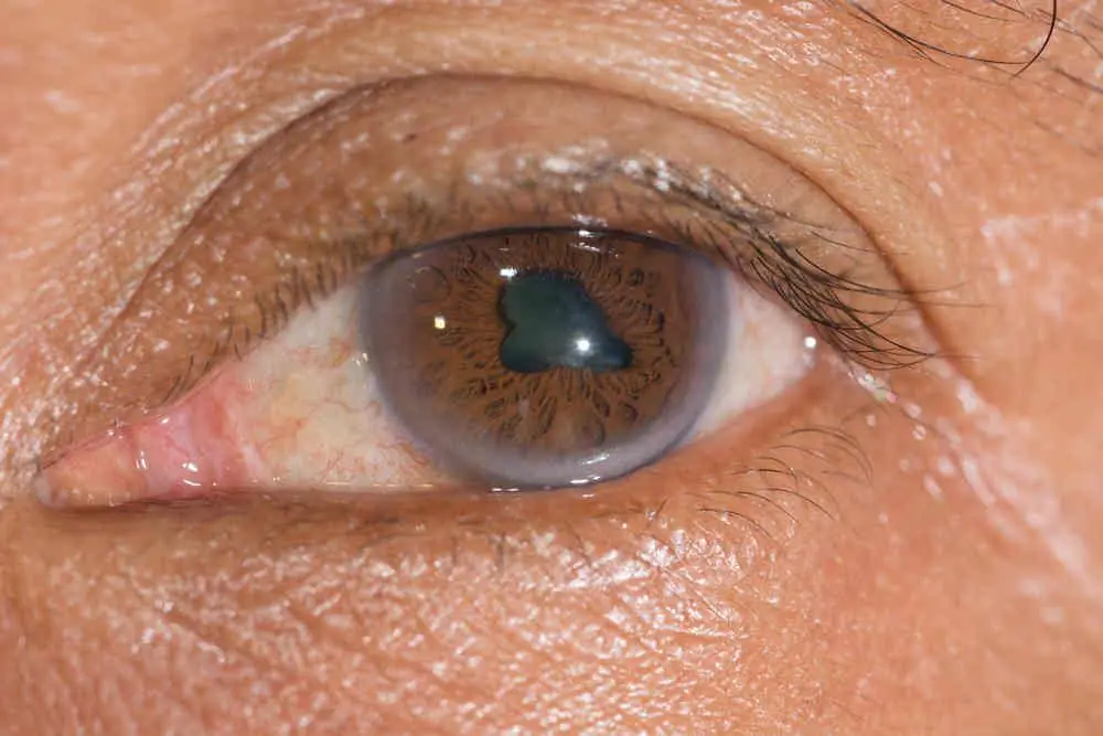 Меланома Рака Глаза - Симптомы, Причины и Лечение