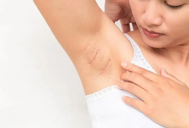 Acanthosis nigricans - Алодоктер