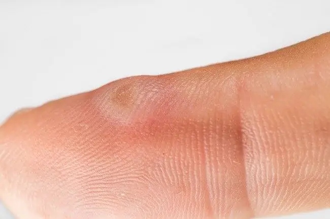 Буллезный эпидермолиз - аллодоктер