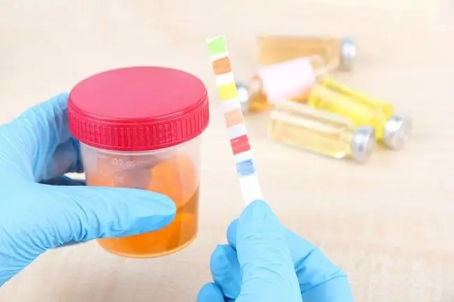 Диабетический кетоацидоз - Симптомы, причины и лечение