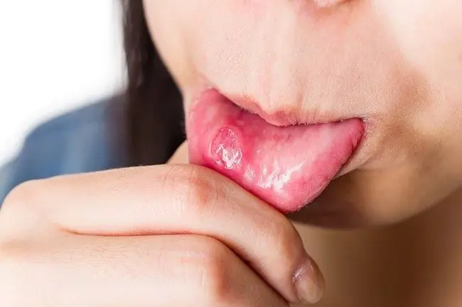 Итраконазол - Преимущества, дозировка, побочные эффекты